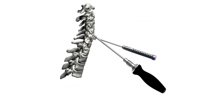Nexxt Spine Launches Guide System