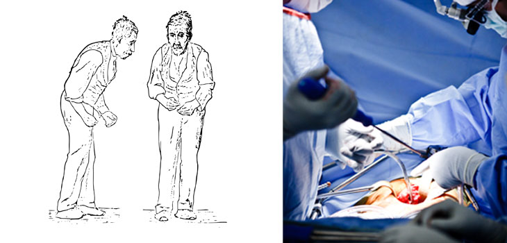 Lumbar Spine Surgery in Parkinson’s Patients: Good Results