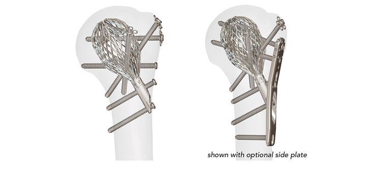 $23.5 Million to Conventus Orthopaedics