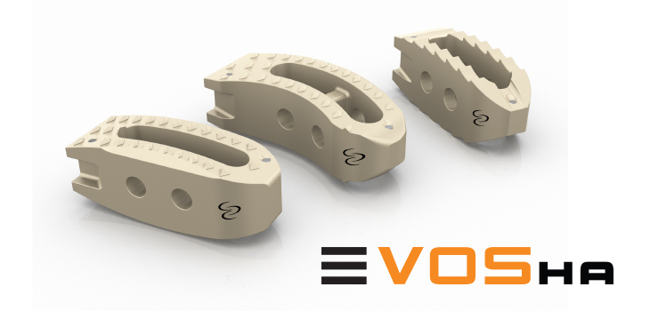 First EVOS-HA PEEK-OPTIMA Implant Installed