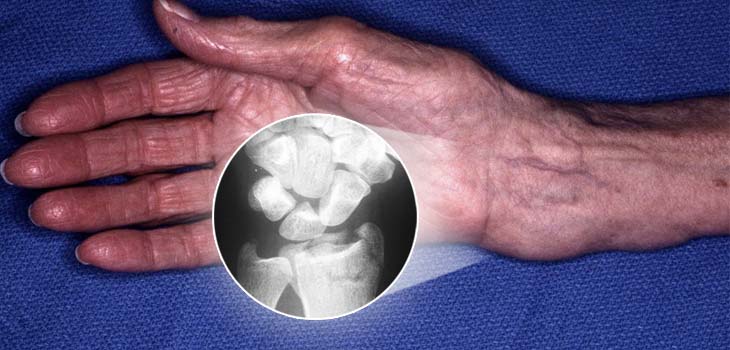 Wrist Fractures Predict Non-Wrist Fractures!