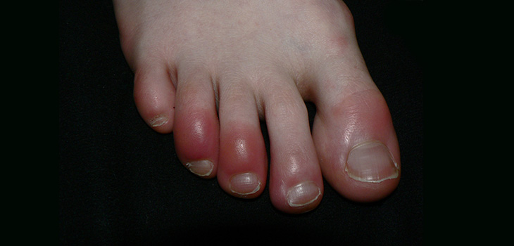 Way to Recreate Bone Lost to Inflammation?