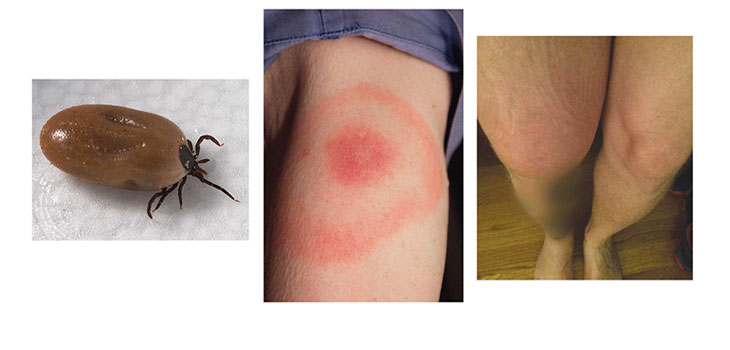 Spontaneous Knee Effusion a Primary Symptom of Lyme Disease