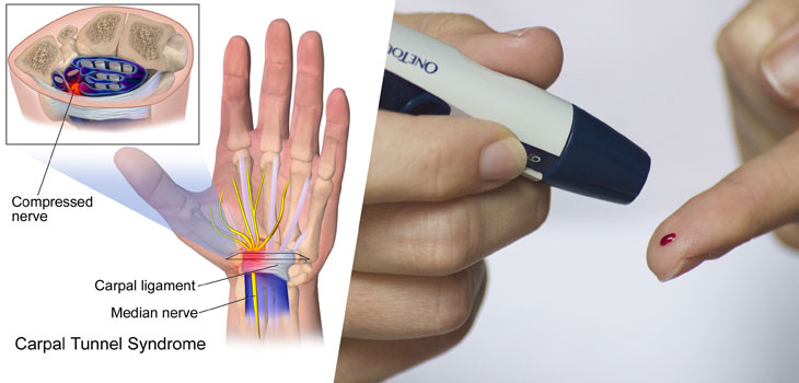 CTS: Diabetes Predicts Symptoms Post-Injection