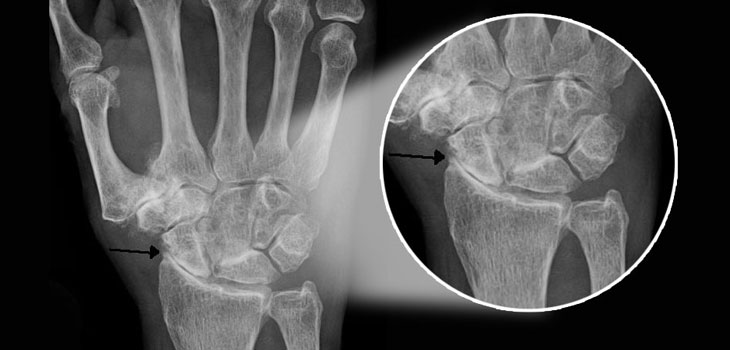 OA Patients: Reduce Pain, Increase Function With Resistance Training