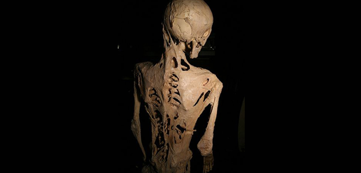New Information on How Rare Bone Disease Begins