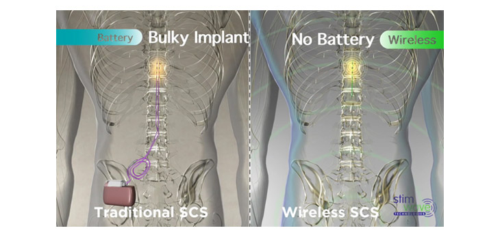 Wireless Spinal Cord Stimulator Cleared by FDA
