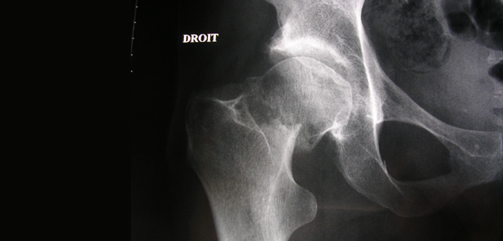 Updated Hip Fracture Treatment Guidelines Issued by AAOS