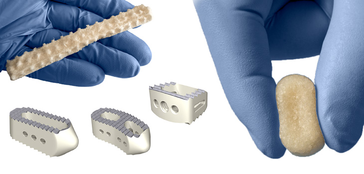 XTANT, SeaSpine and RTI Surgical: Blending Biologics and Hardware