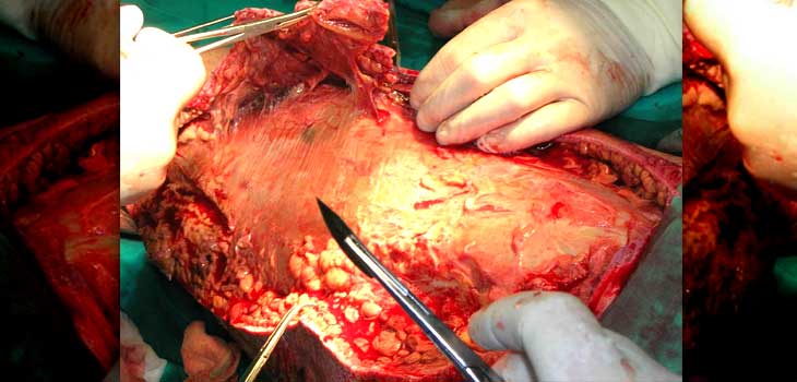 Open Fracture? Saline Trumps Soap and Water