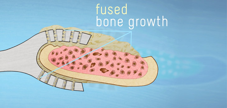 New Screw-Less, Rod-Less Spine Fusion Device From Australia