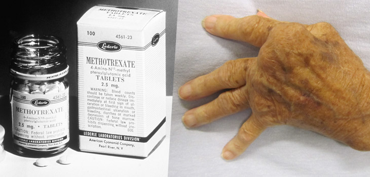 Doctors Underutilizing Methotrexate for RA