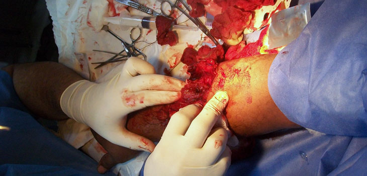 Drive Down Infection With Aminoglycosides // Oral Tranexamic Acid Is Cheaper, Equally Effective in TKA // and More!