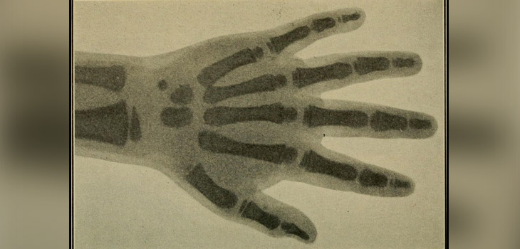 New Study Quantifies Obesity Effect on Carpal Tunnel Syndrome