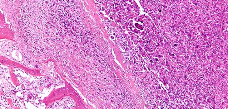Antibody Treatment Could Reduce Amputations in OS Patients