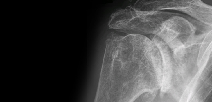 X-rays Fail to Detect Osteoarthritis