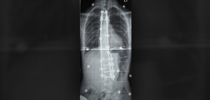 Study: Adolescent Scoliosis Patients Do Better if Counseled