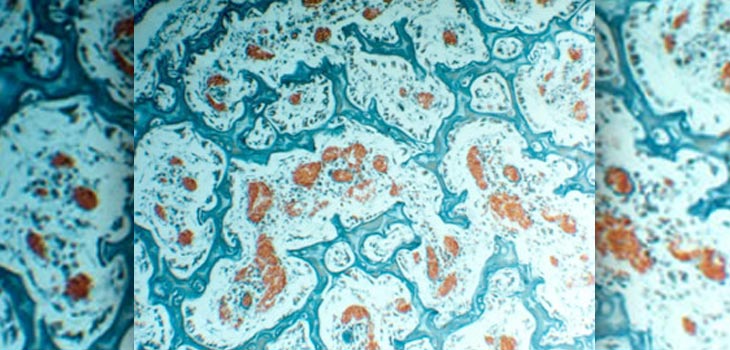 Polymer Spheres Delivers RNA to Bone Wound Site