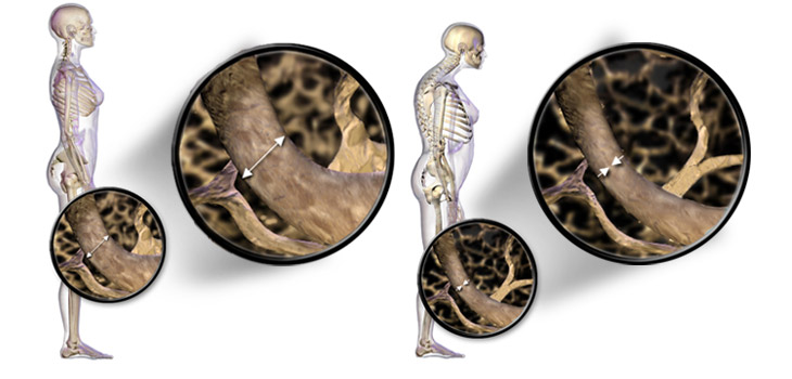 International Osteoporosis Foundation: No Automatic Drug “Holiday!”