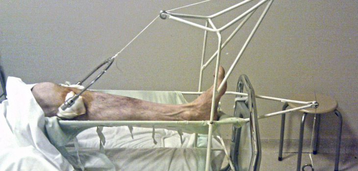 Study Challenges How Bone Fractures Heal
