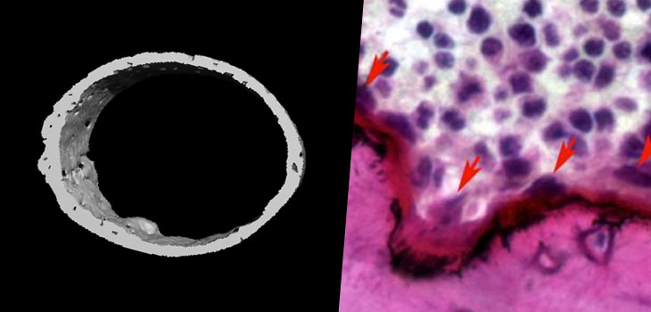 Discovered! Gene That Causes Rare Bone Disease