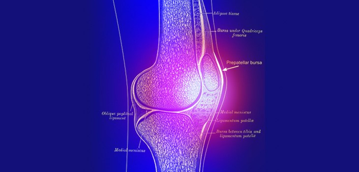 Study: Bone Marrow Lesions Identify Rapid Osteoarthritis
