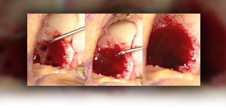 Smith & Nephew’s Bet on Cartilage Repair