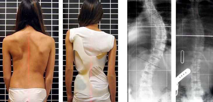 New Official Statement on Adolescent Idiopathic Scoliosis