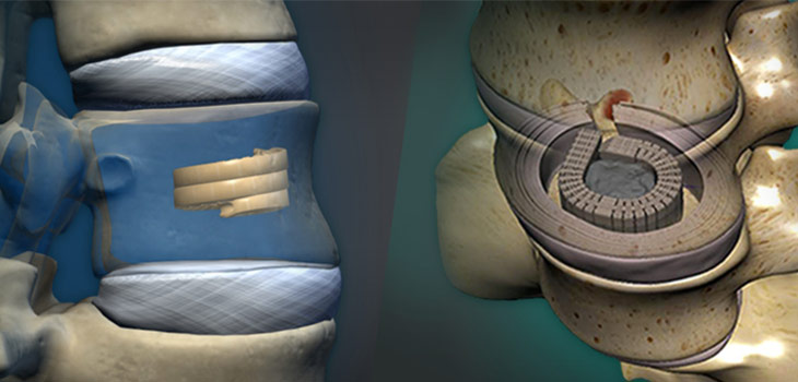 Benvenue Medical Raises $60 Million