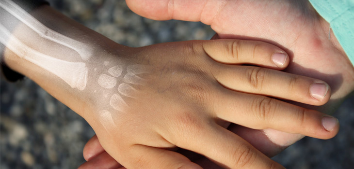 Childhood Fractures Vary by Geography in the UK