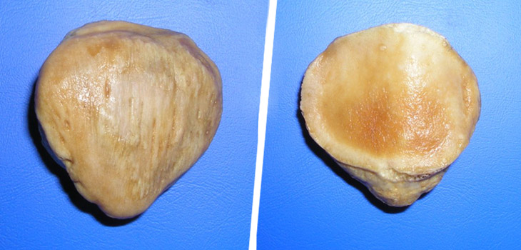 #1 Debated Issue in TKA Is…. // Freeze Nerves Before TKA, Improve Outcomes // and More!
