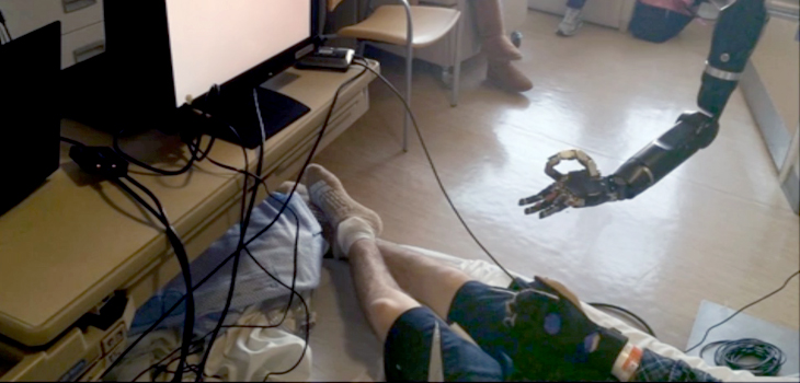 Mind-Controlled Arm Allows Finger Wiggling // Non-Opioid Care Improves Outcomes for Those on Opioids for Pain // and More!