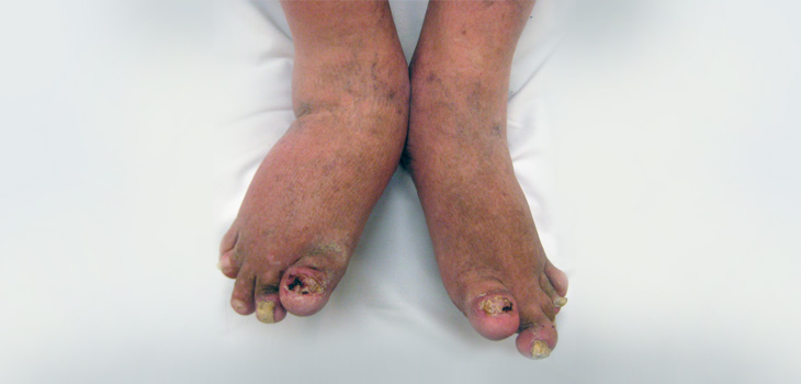 Cosentyx Approved for AS and PsA