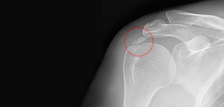 Calcific Tendinitis Involves Increased Blood Vessel, Pain Receptor Growth