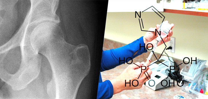Zoledronic Acid Inhibited Bone Loss in HIV Patients