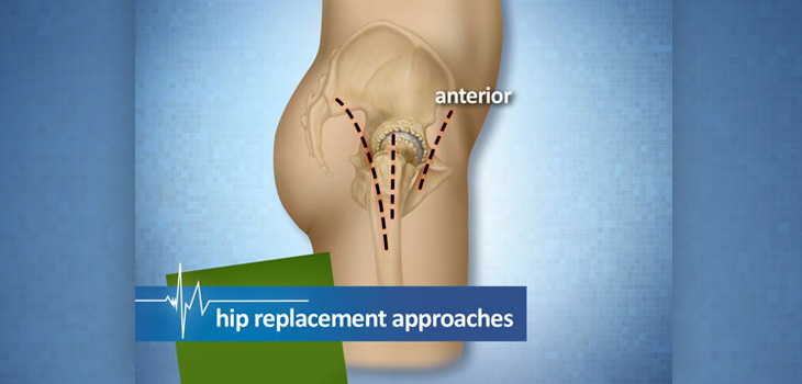 The Rise (and Issues) of Anterior Hip Arthroplasty