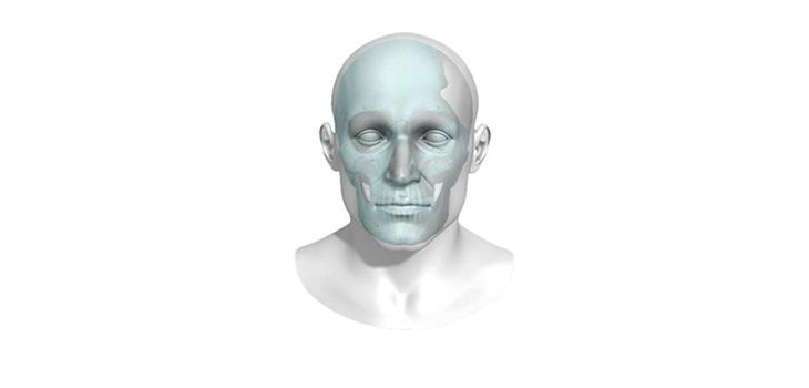 FDA Clears 3D Printed Skull Plate