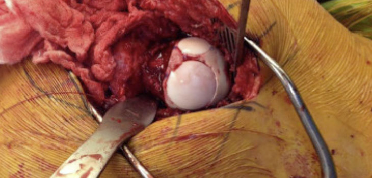 Alternative Technique Extends Life of Resurfaced Joint