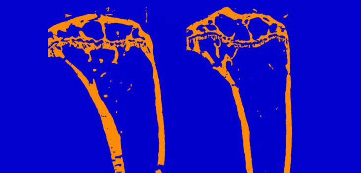Psoriasis Causes Bone Loss!