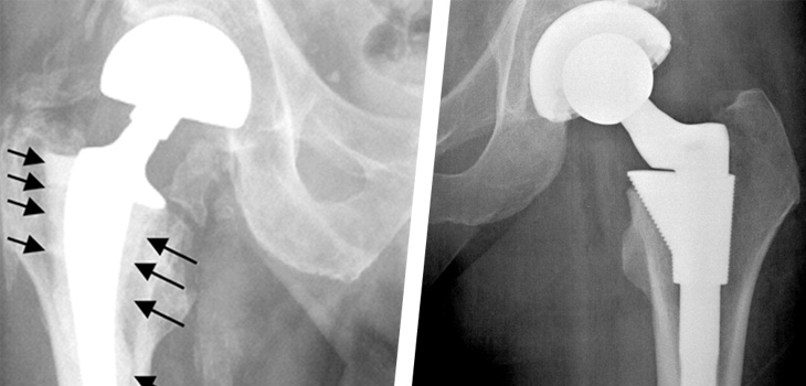 OK to Place Acetabular Cup Outside “Safe Zone?”