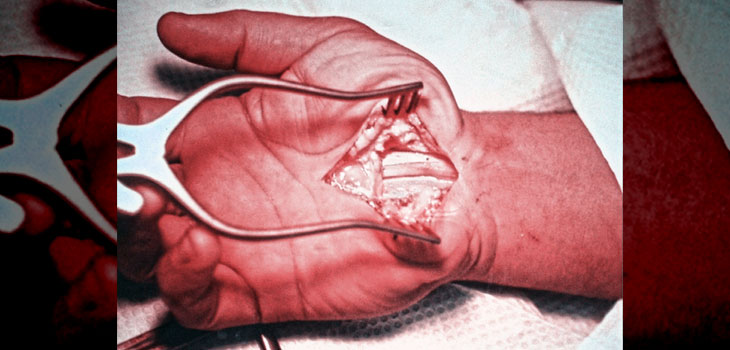 AAOS: New Guidelines for Carpal Tunnel Syndrome