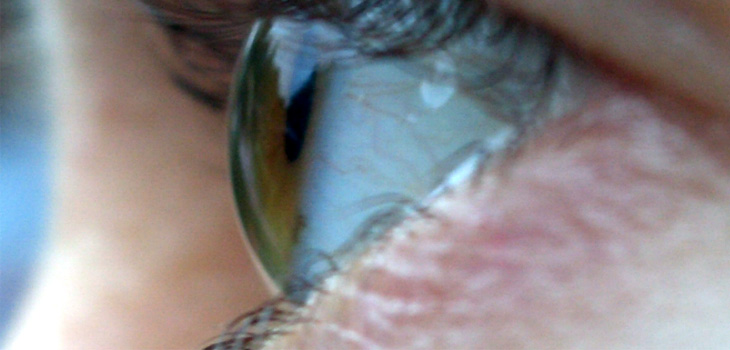 Eye Micro Movement Diagnose Concussions