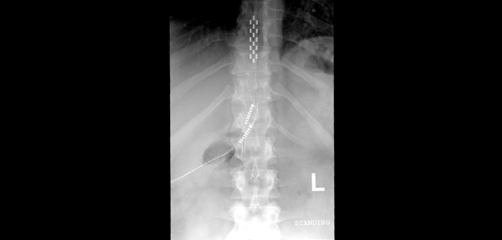Spinal Cord Stimulation Reduces Emotional Response to Pain
