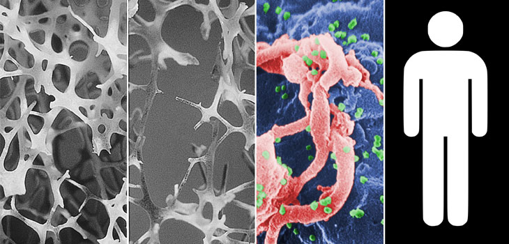Low Bone Mass Greater in HIV-Infected Males