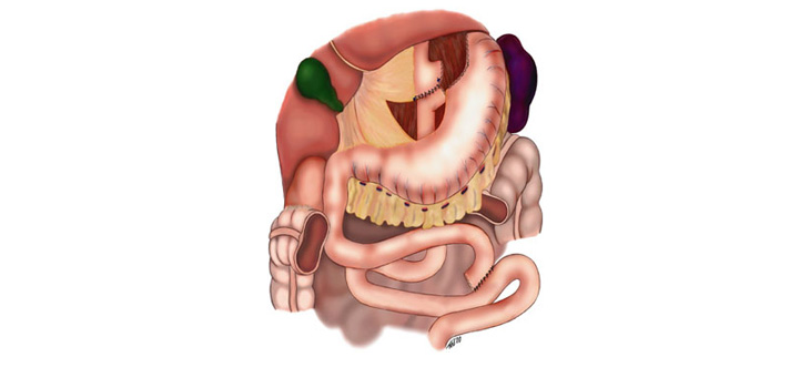 Bariatric Surgery Prior to TKA Cost Effective Option