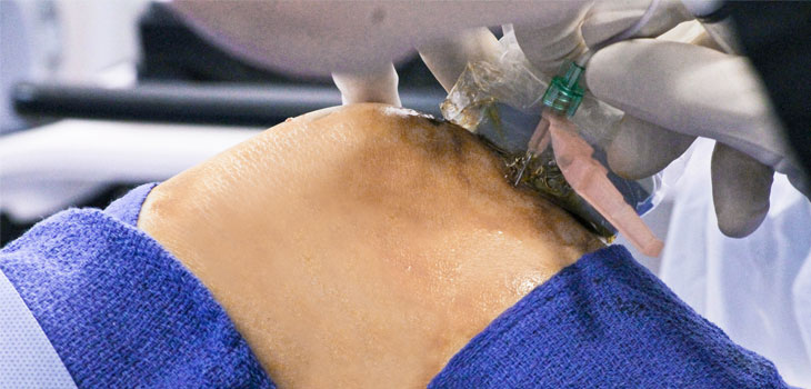 Corticosteroids Could Suppress Immune System