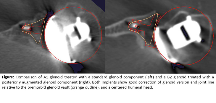 Augmented Glenoid Implant Trumps Standard in TSA