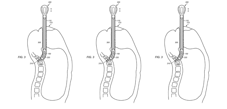 “Natural Orifice” Spine Procedures