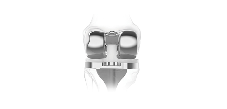 ConforMIS, Inc: Full Commercial Launch of iTotal PS