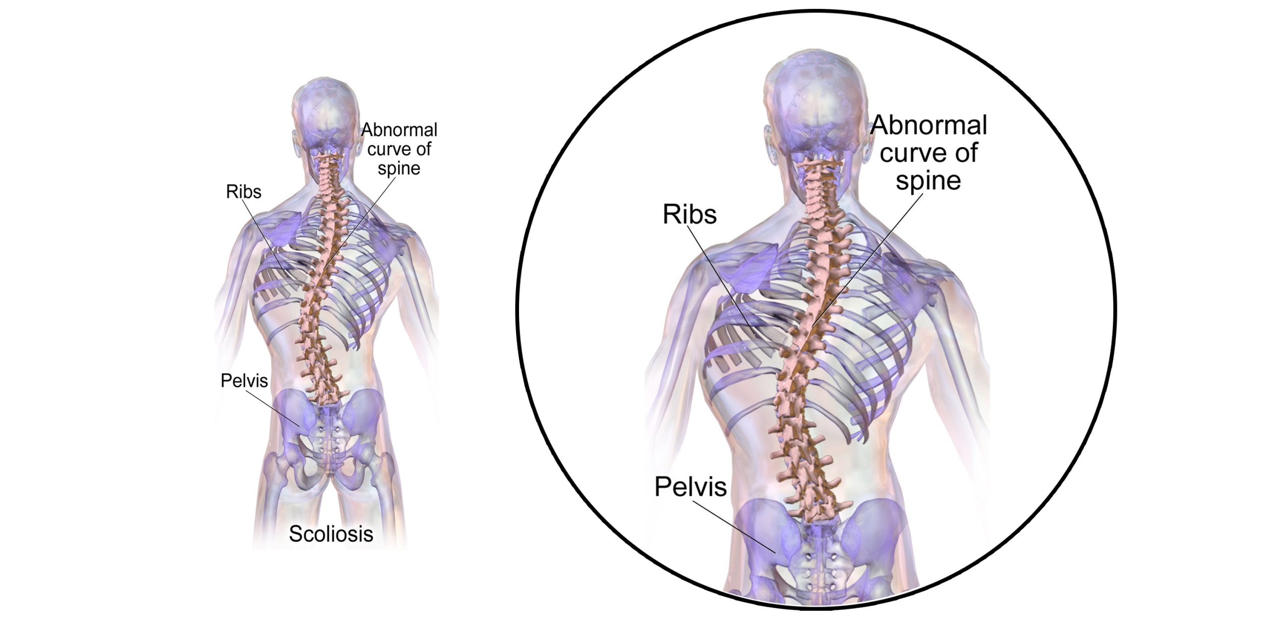 As Disability, Scoliosis Ranks Very High // Using Art to Hone Doctors’ Observational Skills // and More!